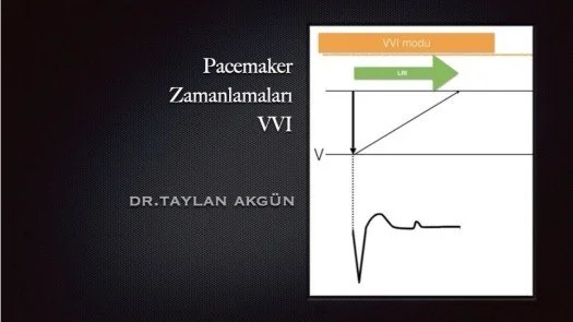 ⁣Pacemaker zamanlamaları-VVI