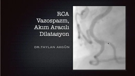 RCA Vazospazm, Akım Aracılı Dilatasyon