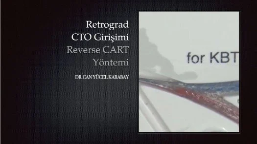Retrograd CTO Girişimi (Reverse CART Yöntemi)