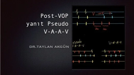 Post-VOP yanıt Pseudo V-A-A-V