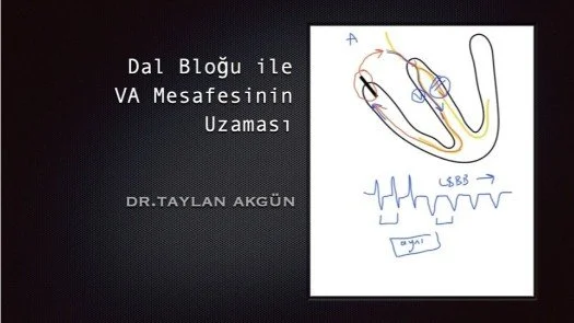 Dal Bloğu ile VA Mesafesinin Uzaması