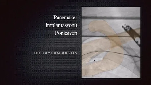 Pacemaker implantasyonu - Ponksiyon