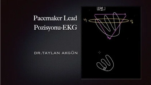 ⁣Pacemaker Lead Pozisyonu-EKG