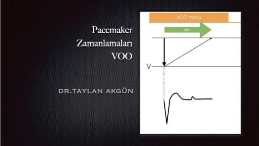 Pacemaker Zamanlamaları-VOO