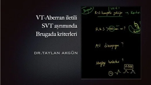 ⁣VT-Aberran iletili SVT ayrımında Brugada kriterleri