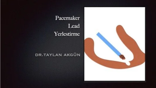 Pacemaker-lead yerlestirme