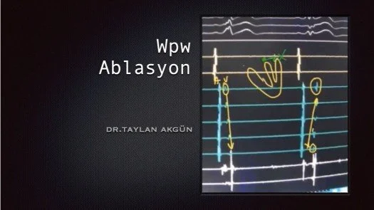 Wpw Ablasyon
