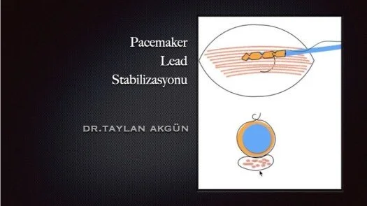 ⁣Pacemaker-Lead Stabilizasyonu