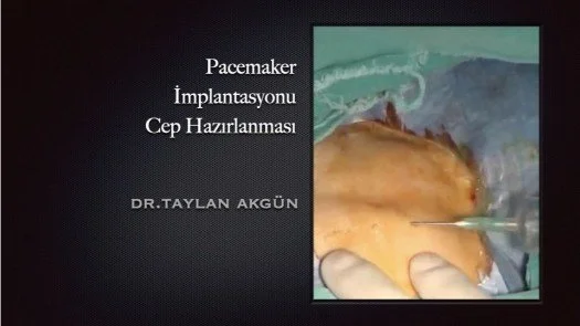 Pacemaker İmplantasyonu- Cep Hazırlanması