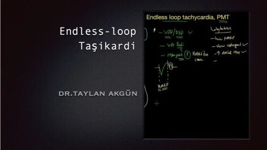 ⁣Endless-loop Taşikardi