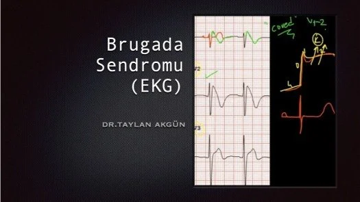 ⁣Brugada Sendromu (EKG)