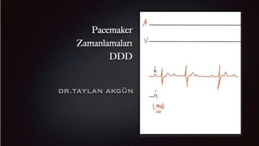 Pacemaker Zamanlamaları-DDD