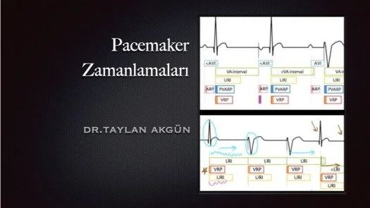 ⁣Pacemaker Zamanlamaları