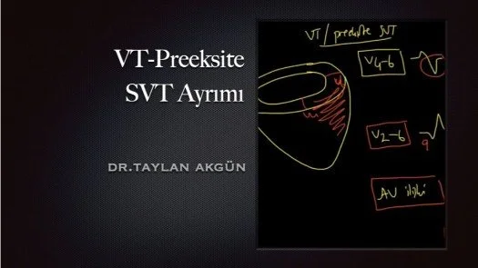 ⁣VT-Preeksite SVT Ayrımı