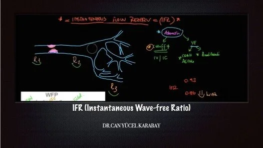 IFR (Instantaneous Wave-free Ratio)