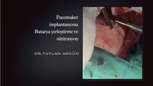 Pacemaker implantasyonu - Batarya yerleştirme ve sütürasyon