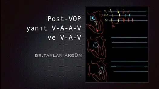 Post-VOP yanıt V-A-A-V ve V-A-V