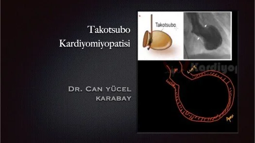 ⁣Takotsubo Kardiyomiyopatisi