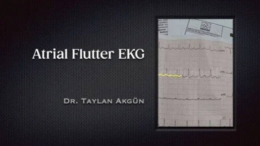 ⁣Atrial Flutter EKG