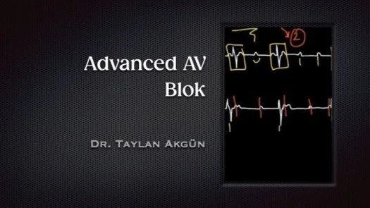 ⁣Advanced AV Blok