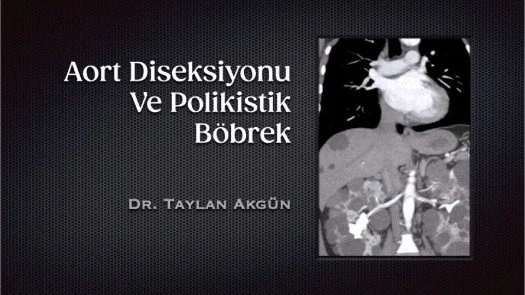 ⁣Aort Diseksiyonu Ve Polikistik Böbrek