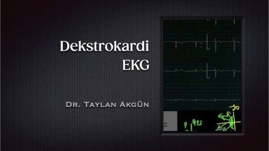 ⁣Dekstrokardi EKG