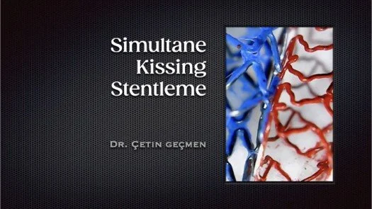 Simultane Kissing Stentleme