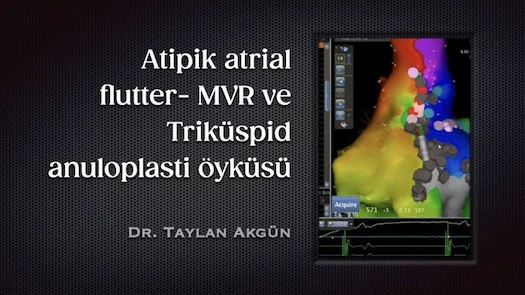 ⁣Atipik atrial flutter- MVR ve Triküspid anuloplasti öyküsü
