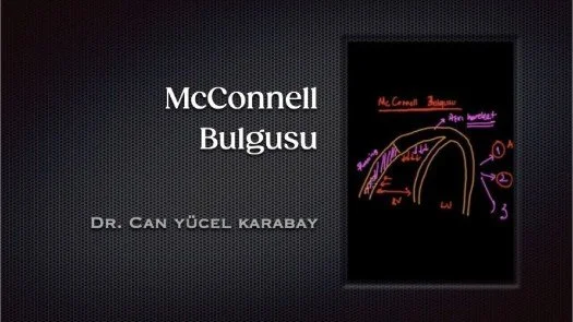 ⁣McConnell Bulgusu